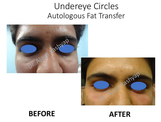 facial fat transfer treatment in south delhi
