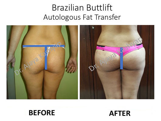 brazilian butt lift surgery in delhi