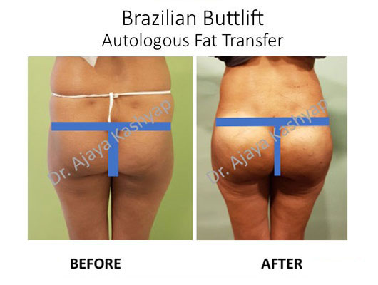 brazilian butt lift surgery in india