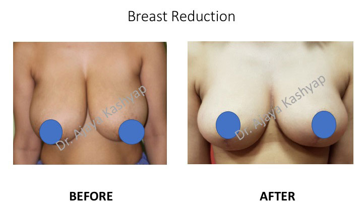 breast reduction surgeon in India