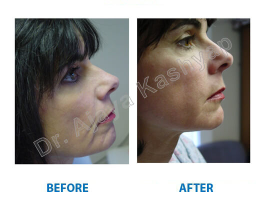 facelift surgery in india