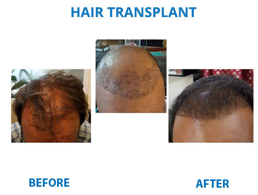 PRP hair loss treatment in south delhi