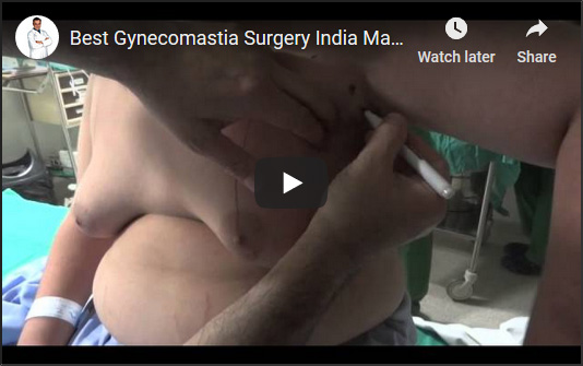 best gynecomastia surgery 