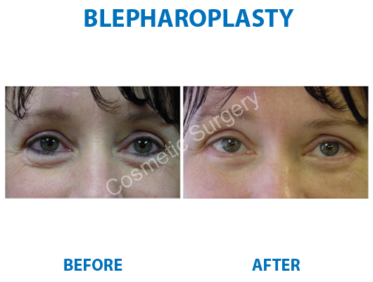 eyelid surgery in delhi