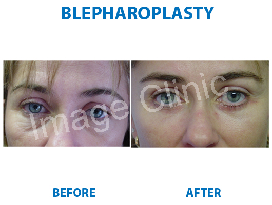 eyelid surgery in india