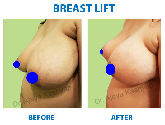 breast surgery india
