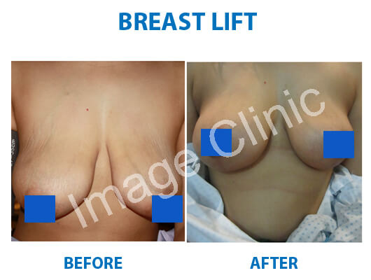 breast surgery cost