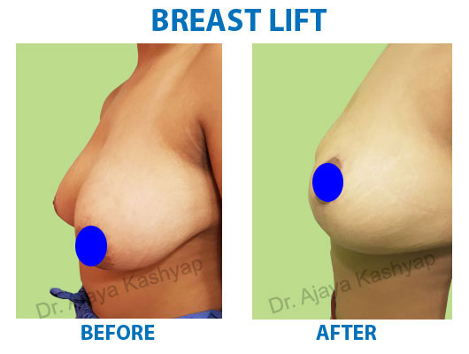 breast lift surgery cost in delhi