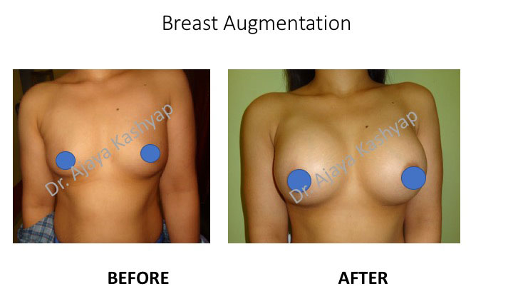 breast implant surgery in delhi