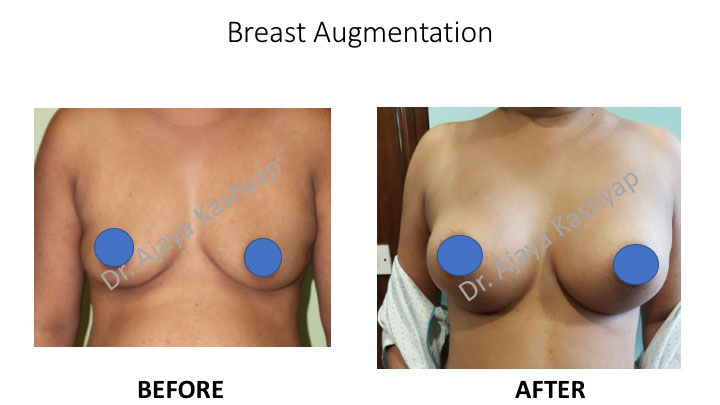 breast augmentation surgery in india