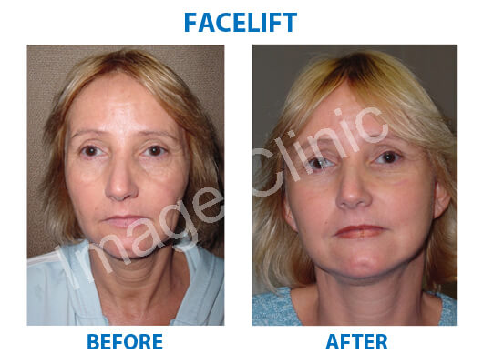 facelift surgery clinic