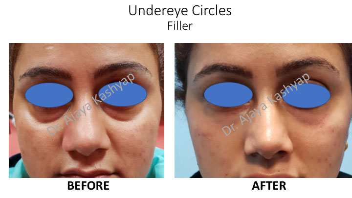 under eye filler treatment in delhi