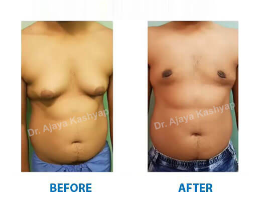 male breast reduction surgery in india
