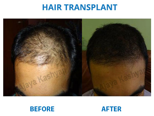 FUE hair transplant surgery in aya nagar, delhi