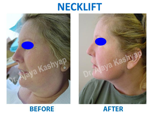 neck lift surgery in india