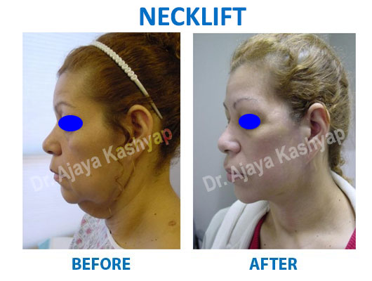 neck lift surgeon in delhi