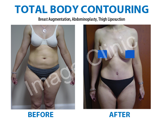 total body contouring