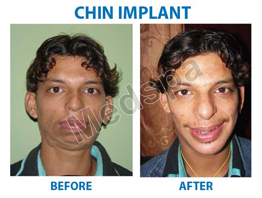chin implant