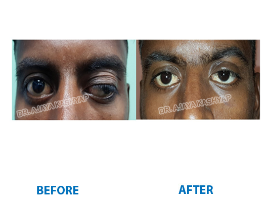 ptosis eye repair