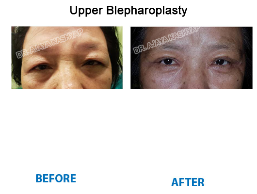 upper blepharoplasty